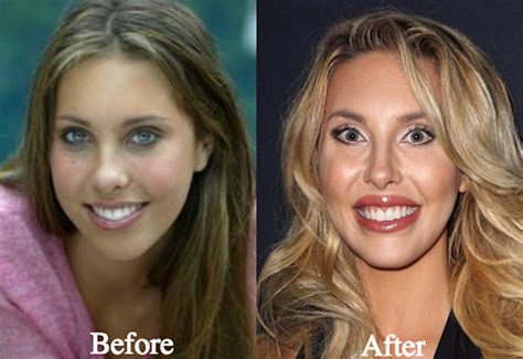 chloe lattanzi net worth|chloe lattanzi plastic surgery.